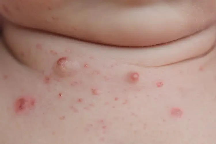 新生兒脖子上起濕疹能夠徹底治愈嗎(圖4)