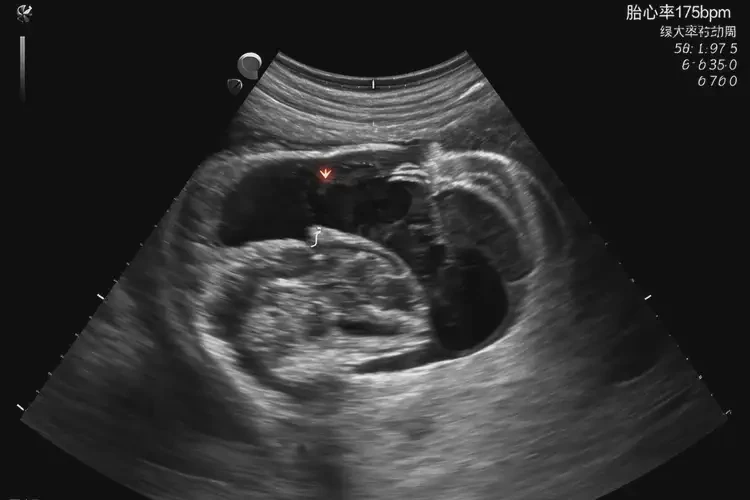 孕9周1天胎心175正常嗎(圖4)