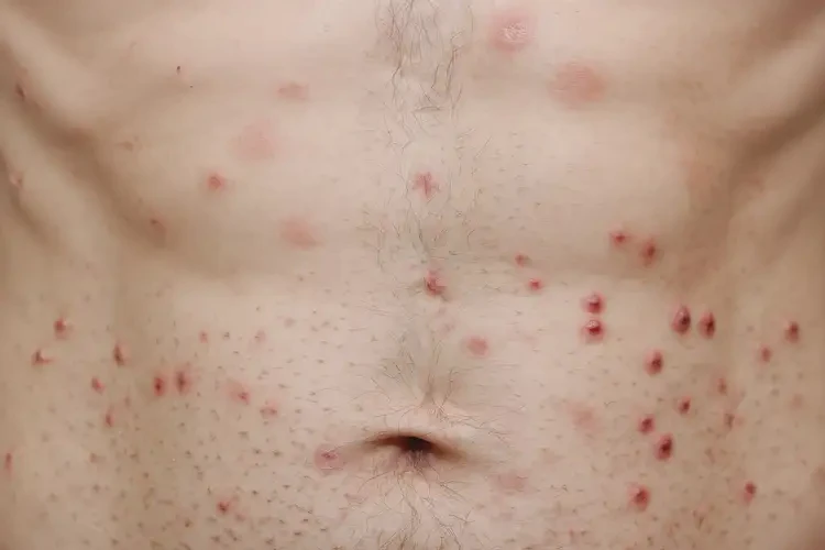 男性肚子出濕疹可以徹底自愈嗎(圖4)