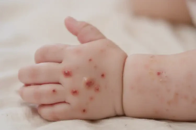 嬰兒手上偶爾起濕疹不管它會(huì)自己自愈嗎(圖3)