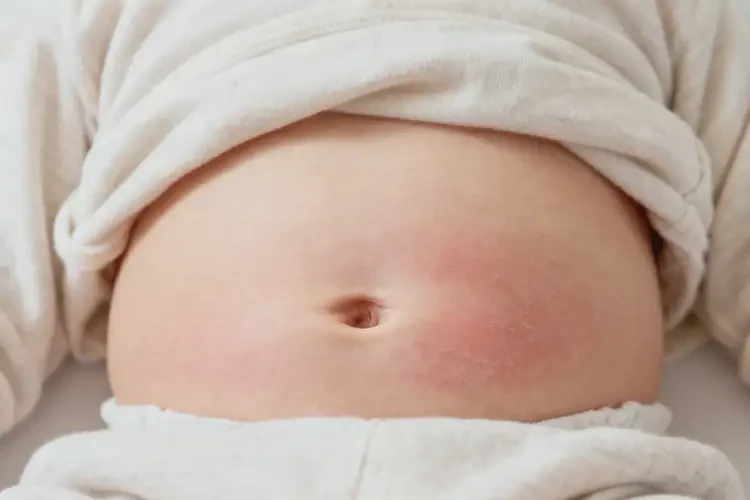 寶寶肚子出濕疹不管它會自己痊愈嗎(圖4)