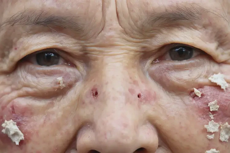 老人臉上容易長濕疹可以徹底自愈嗎(圖4)