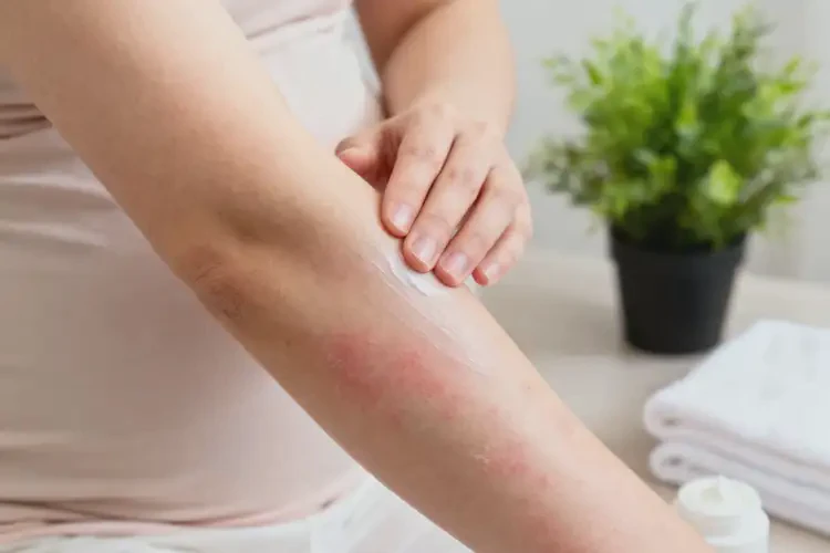 哺乳期媽媽手臂有濕疹能不能徹底自愈(圖1)