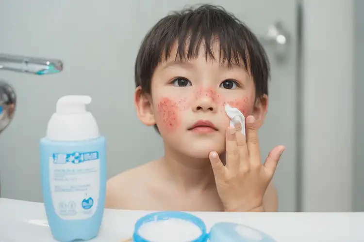 孩子面部有濕疹可不可以徹底自愈(圖4)