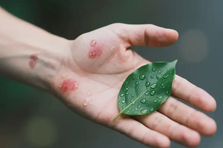 男性手臂經(jīng)常長濕疹能徹底自愈嗎(圖3)