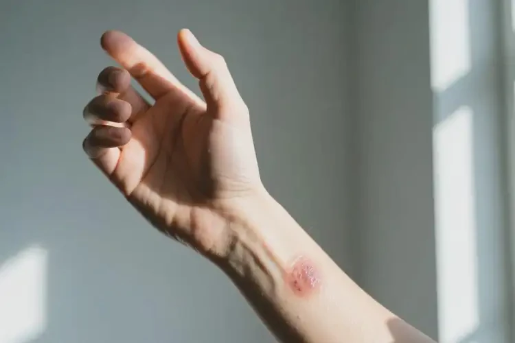 男性手臂經(jīng)常長濕疹能徹底自愈嗎(圖1)