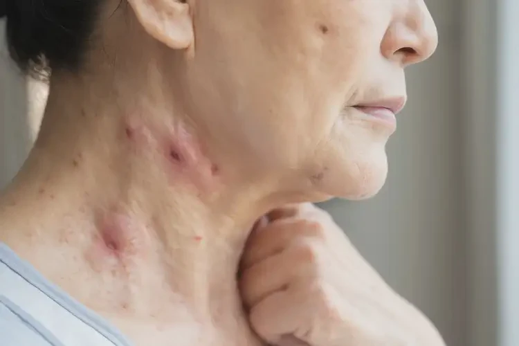 女人脖子有濕疹能徹底自愈嗎(圖3)