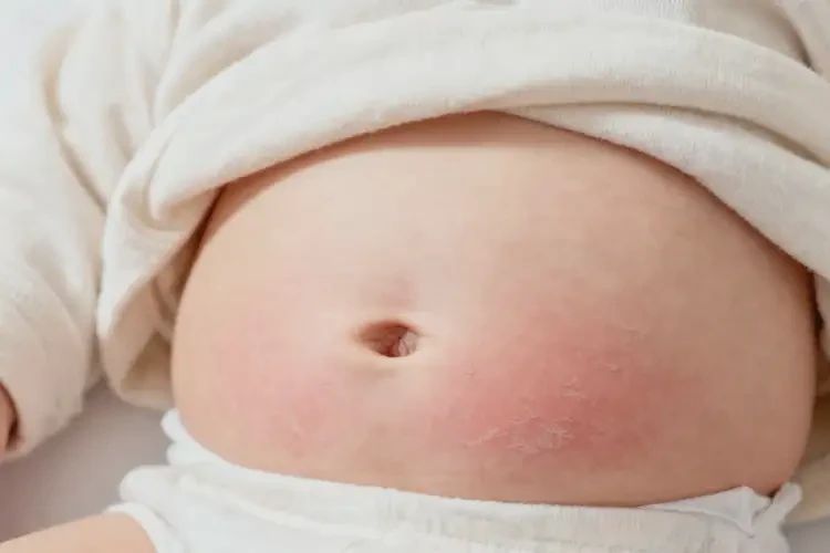 寶寶肚子出濕疹不管它會自己痊愈嗎(圖3)