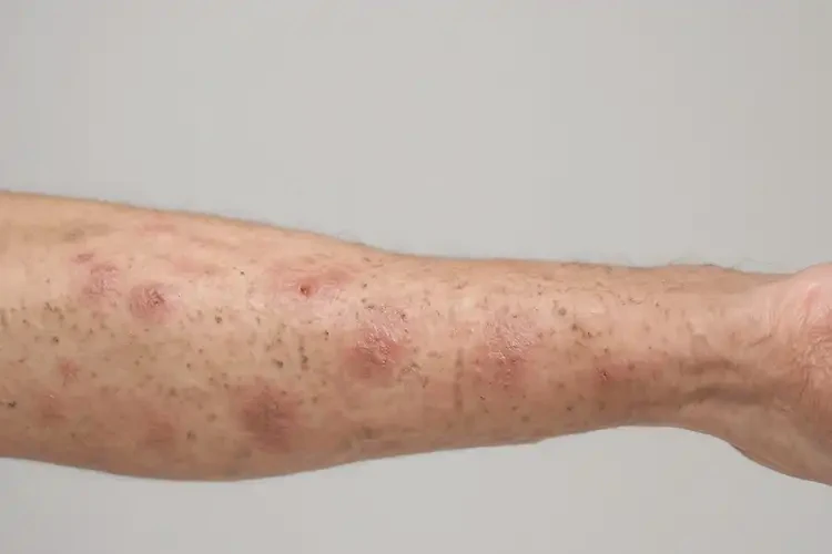 大学生脚上偶尔长湿疹不管它会自己痊愈吗(图2)