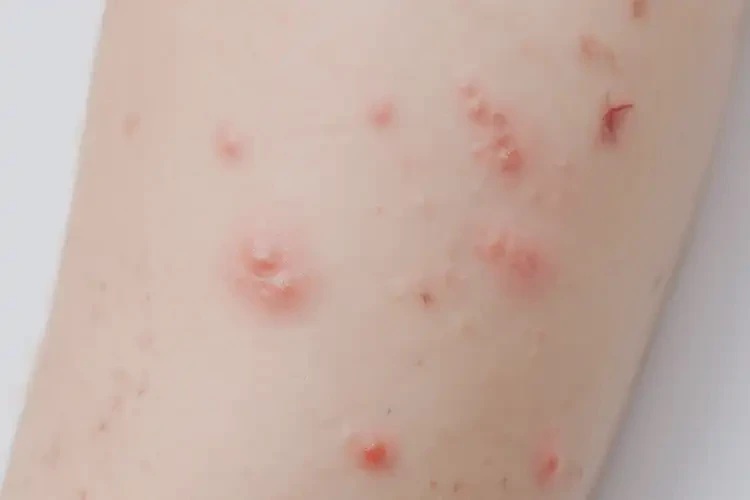 少兒屁股經(jīng)常長(zhǎng)濕疹不管它會(huì)自己自愈嗎(圖4)