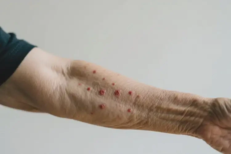 老年人手臂上偶爾長濕疹不管它會自己痊愈嗎(圖3)