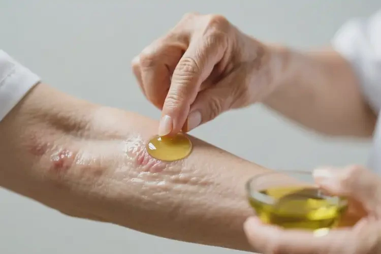 老人手臂经常起湿疹不管它会自己好吗(图3)