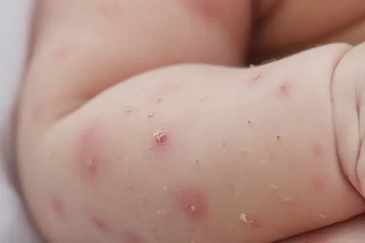 新生兒手臂上容易起濕疹可不可以徹底自愈(圖4)