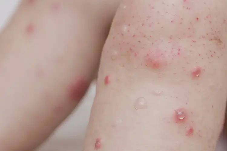 少兒全身經(jīng)常起濕疹不管它會(huì)自己自愈嗎(圖4)