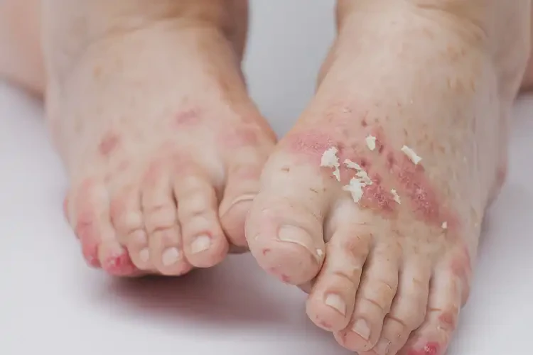 兒童腳上長(zhǎng)濕疹可以徹底自愈嗎(圖4)