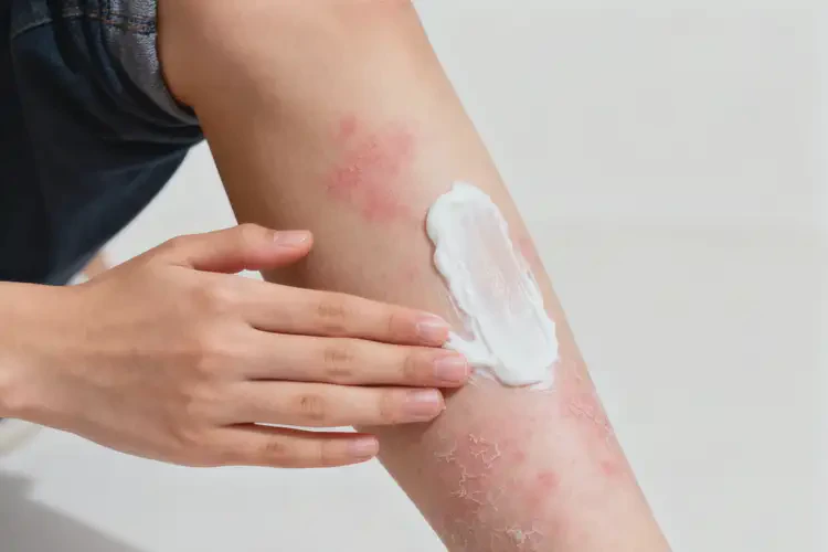 青少年小腿經(jīng)常起濕疹不管它會(huì)自己痊愈嗎(圖3)