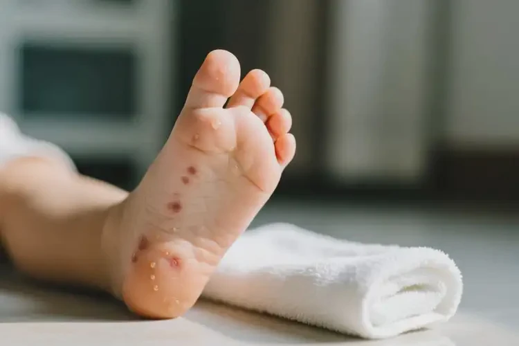 小兒腳上有濕疹不管它會(huì)自己自愈嗎(圖3)