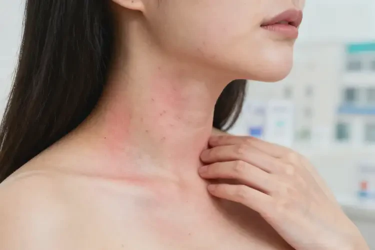 孕婦脖子上經(jīng)常起濕疹能靠自己自愈嗎(圖1)