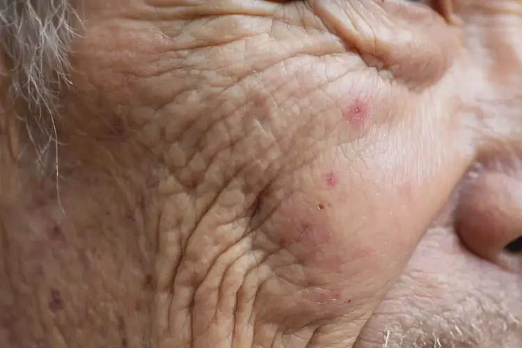 老年人四肢經(jīng)常長濕疹能徹底自愈嗎(圖4)