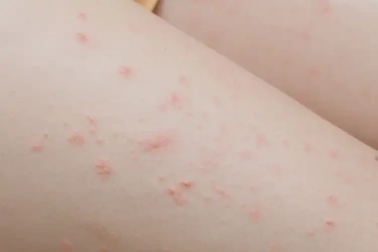 女生大腿上偶爾長濕疹能靠自己自愈嗎(圖4)