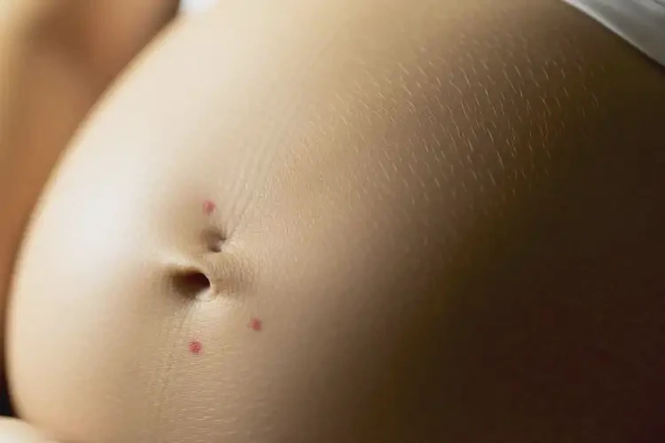產(chǎn)婦肚子上偶爾長(zhǎng)濕疹可不可以徹底自愈(圖3)