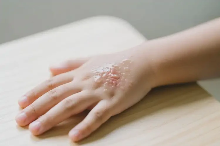 兒童手上起濕疹不管它會(huì)自己痊愈嗎(圖1)