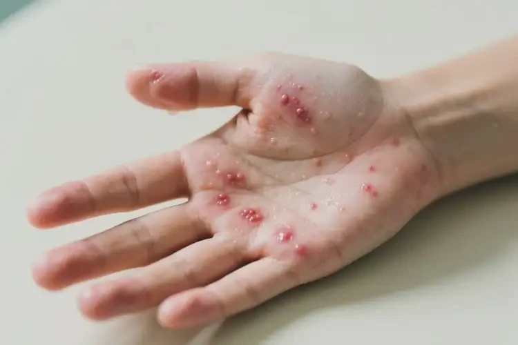男生手上容易長濕疹能徹底自愈嗎(圖4)