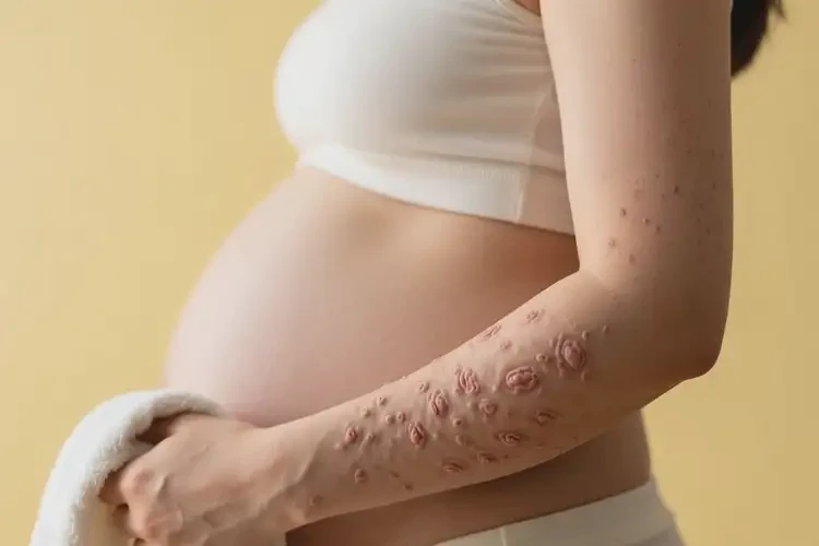 產(chǎn)婦四肢經(jīng)常長濕疹不管它會自己好嗎(圖1)