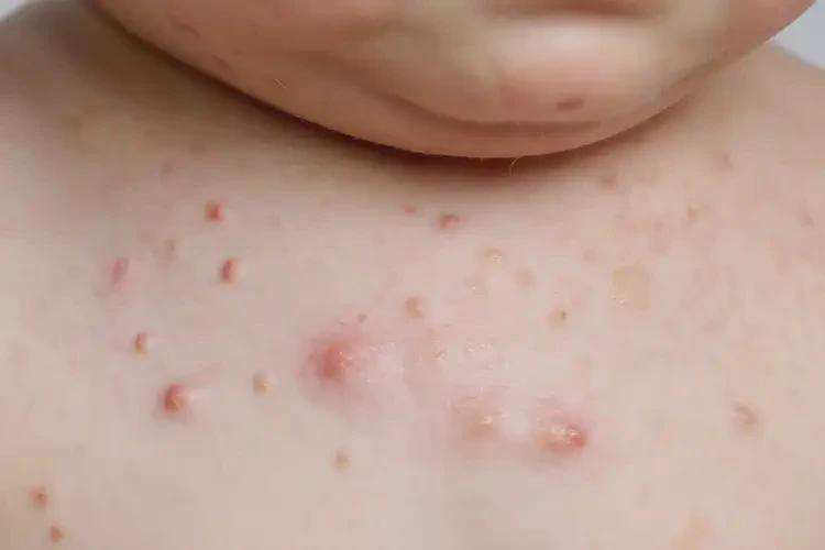 幼兒脖子上有濕疹能靠自己自愈嗎(圖4)