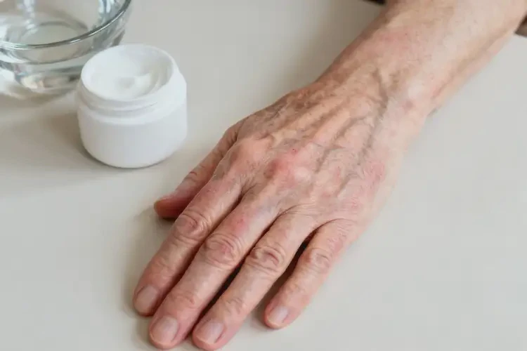 老年人手上偶爾起濕疹能徹底自愈嗎(圖2)