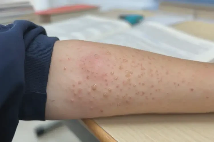 中學生手臂上起濕疹可不可以徹底自愈(圖4)