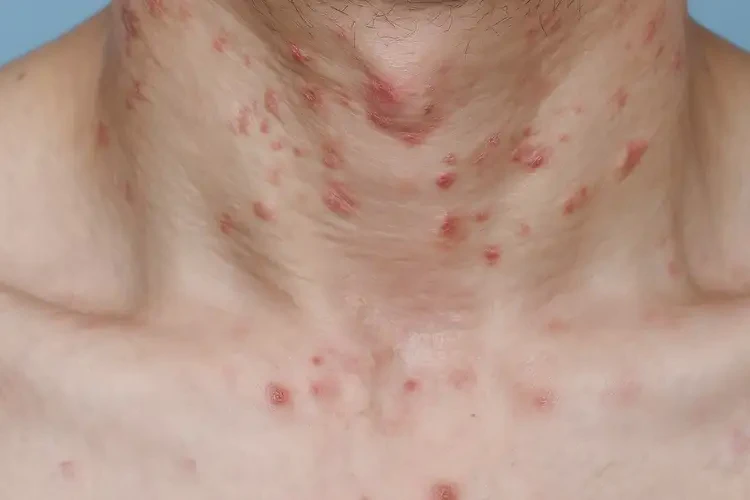 青年人脖子偶爾長(zhǎng)濕疹能夠徹底治愈嗎(圖4)