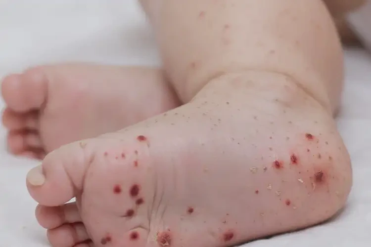 嬰幼兒腳上經(jīng)常起濕疹不管它會(huì)自己自愈嗎(圖4)