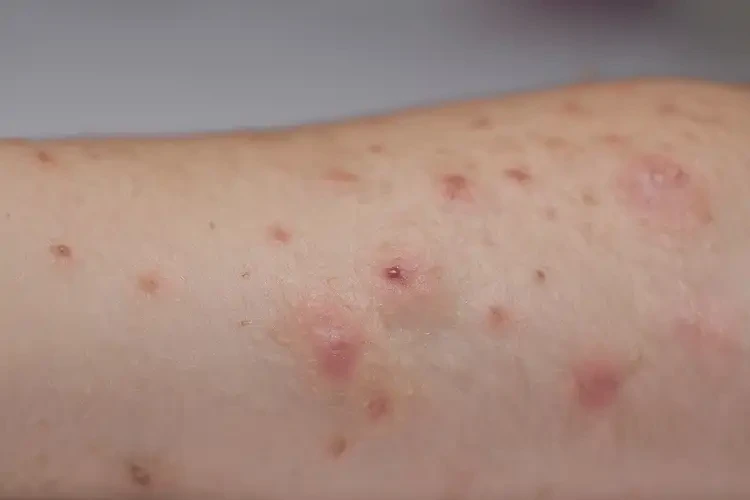 小孩身上经常长湿疹不管它会自己好吗(图4)