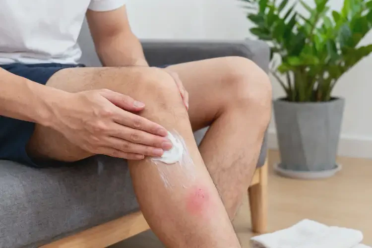 男性大腿上經(jīng)常長濕疹不管它會自己好嗎(圖1)