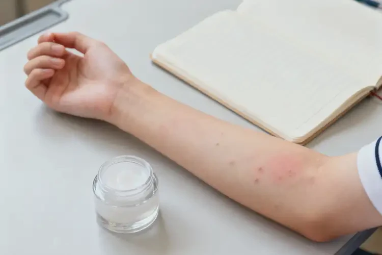 大學生手臂上經常起濕疹能夠徹底治愈嗎(圖4)