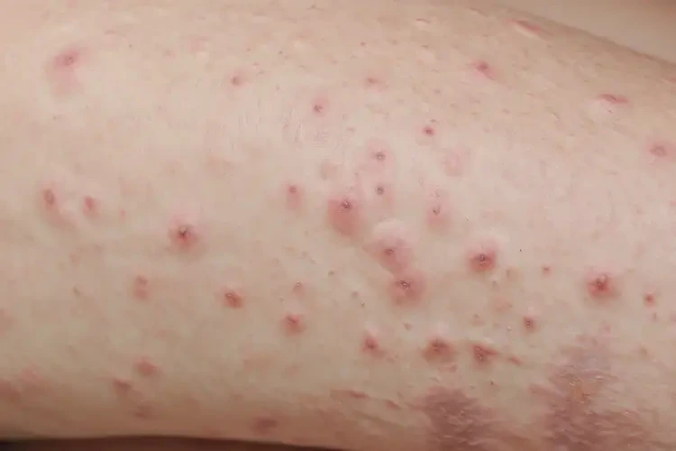 女人四肢容易長濕疹能不能徹底自愈(圖4)