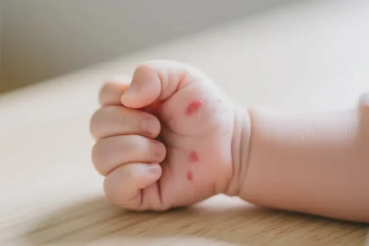 新生儿全身偶尔长湿疹可以彻底自愈吗(图3)