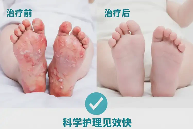 新生儿脚上容易起湿疹能靠自己自愈吗(图1)