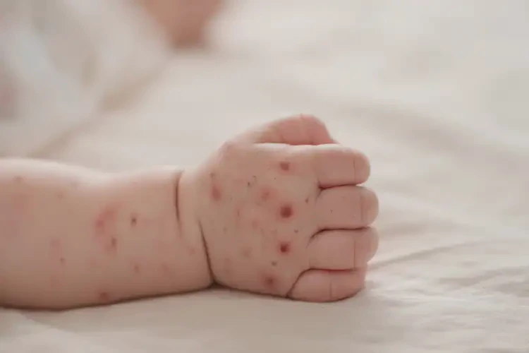 嬰兒手上偶爾起濕疹不管它會(huì)自己自愈嗎(圖2)