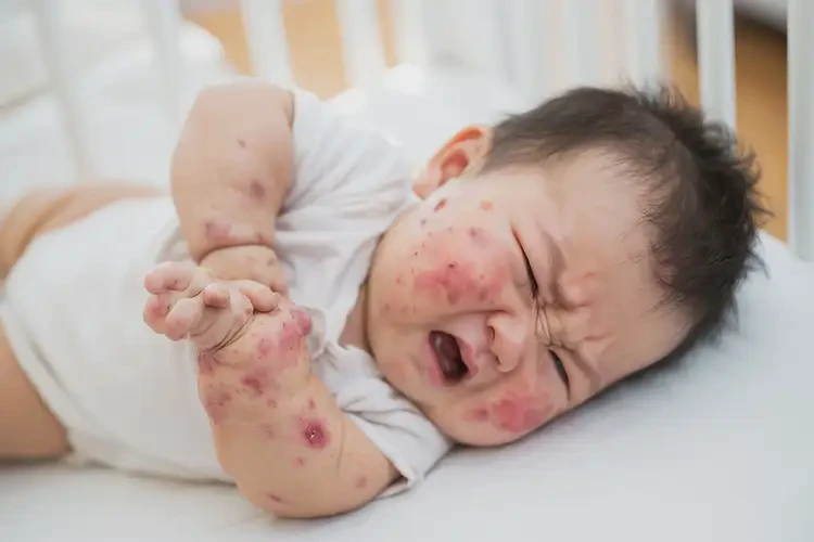宝宝全身出湿疹能靠自己自愈吗(图4)