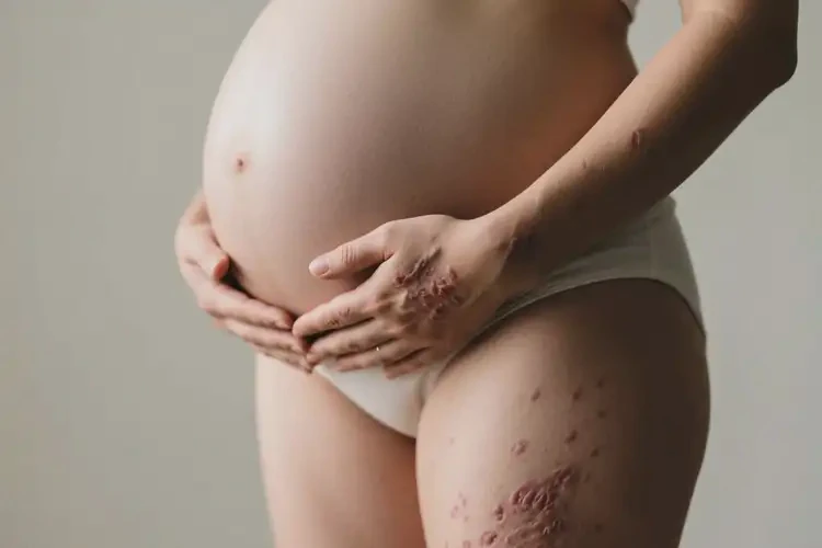 孕婦四肢長濕疹能靠自己自愈嗎(圖4)
