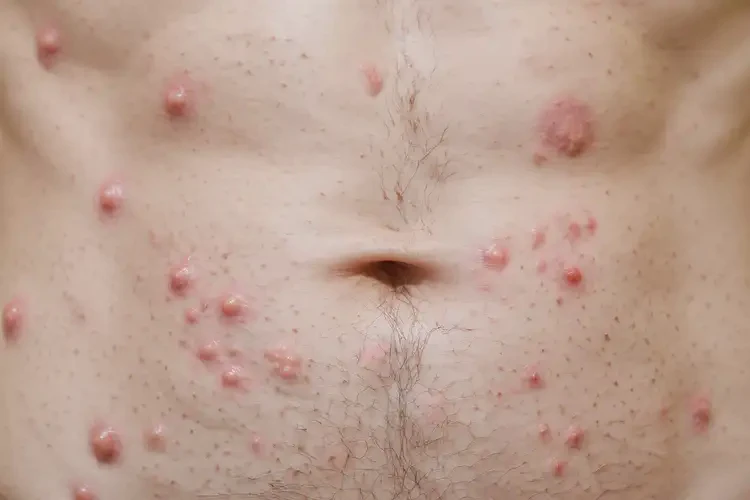 青年人肚子上經(jīng)常長濕疹能不能徹底自愈(圖4)