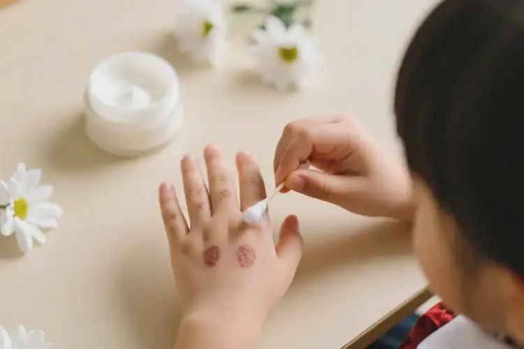 小學(xué)生手上經(jīng)常長(zhǎng)濕疹可以徹底自愈嗎(圖2)