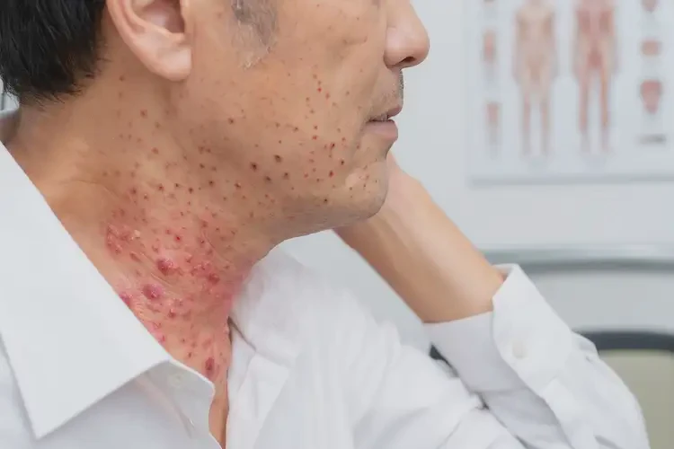 男人脖子偶爾起濕疹可以徹底自愈嗎(圖4)