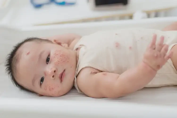 小孩屁股上偶爾起濕疹可不可以徹底自愈(圖4)