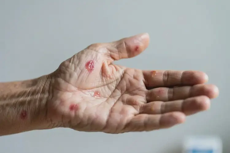 高齡老人手臂出濕疹不管它會自己自愈嗎(圖2)