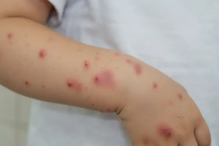 小孩全身出濕疹能靠自己自愈嗎(圖3)