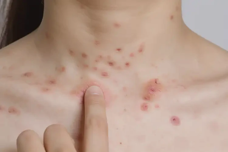 大學(xué)生脖子上出濕疹可以徹底自愈嗎(圖4)