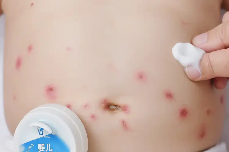 孩子肚子上容易起濕疹可以徹底自愈嗎(圖3)